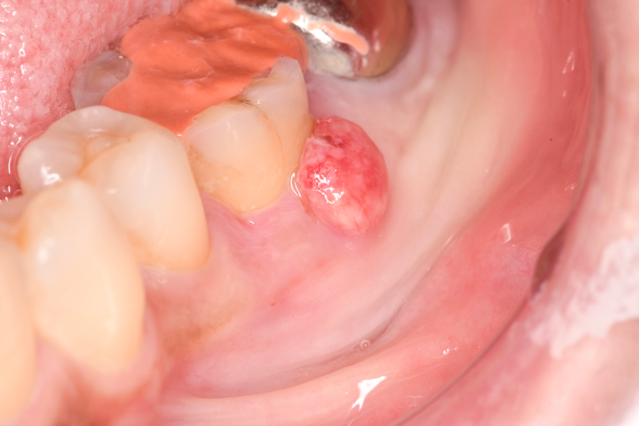 歯内感染が原因の瘻孔