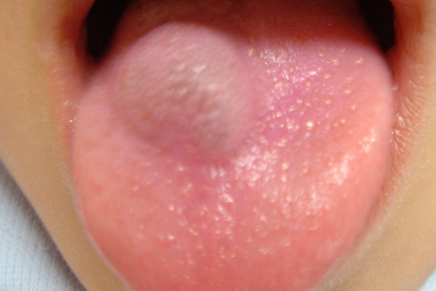 舌 血管腫
